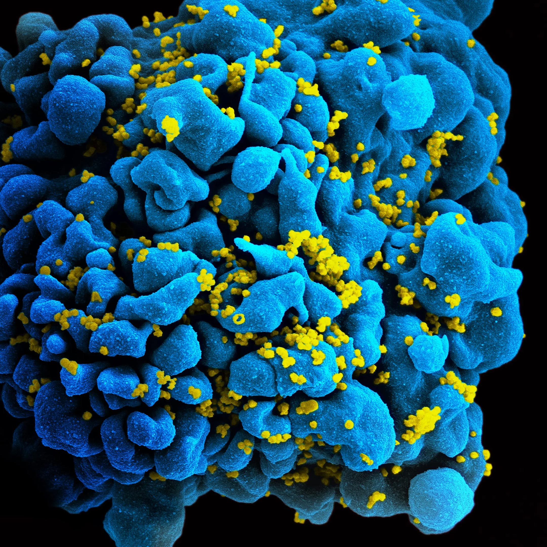 Dos personas controlaron el VIH después de suspender el tratamiento de terapia antirretroviral